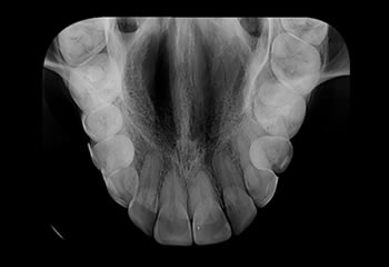 Radiografias Oclusais