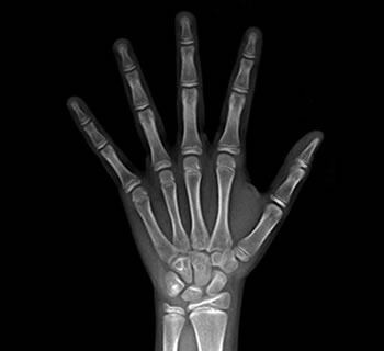 Radiografias Carpais