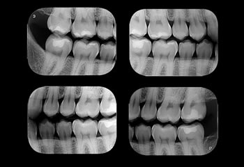 Radiografias Interproximais