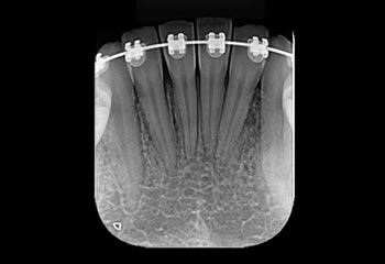 Radiografias Periapicais