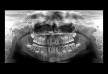 Radiografias Panorâmica